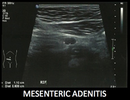 Boosey Ultrasound - Mesenteric Adenitis_2